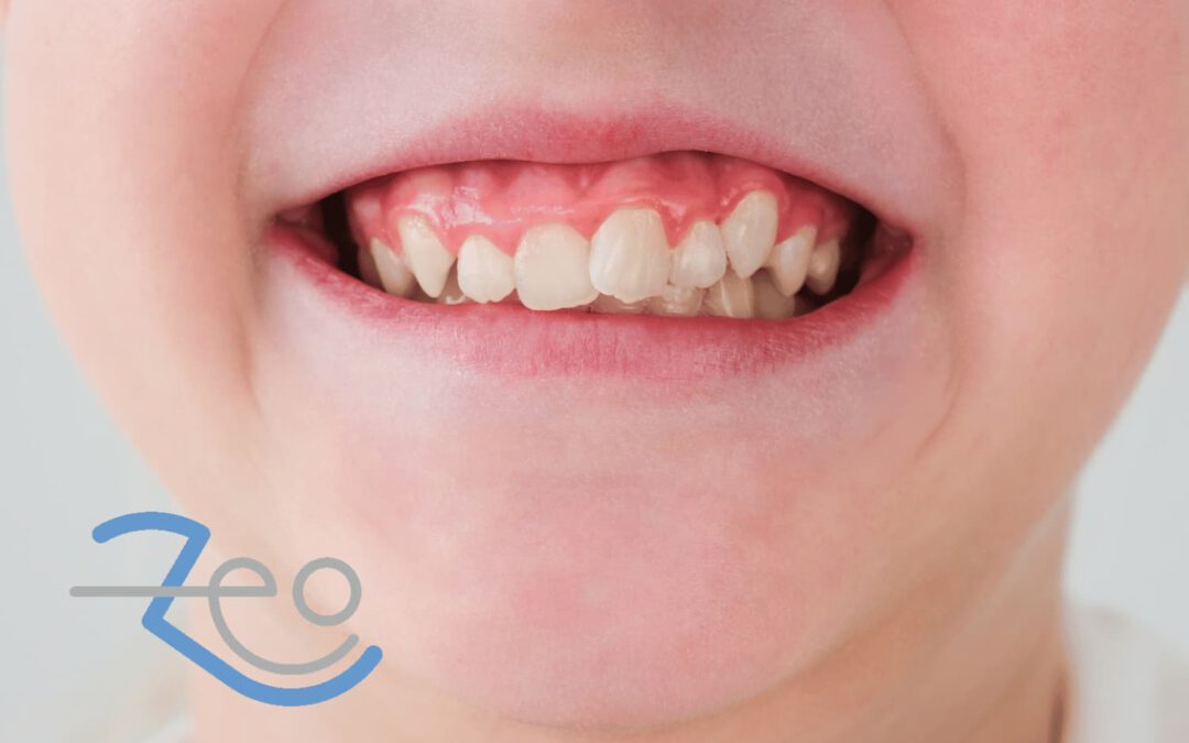 Dientes apiñados
