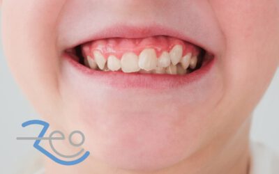 Dientes apiñados: causas y solución