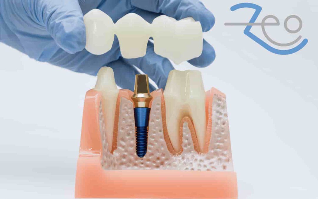Prótesis dentales