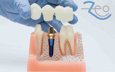Prótesis dentales: tipos y cuál elegir