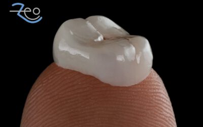 Coronas dentales: qué materiales existen y cuánto duran realmente