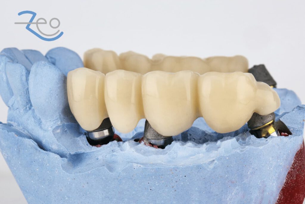 Puente dental o implante dental