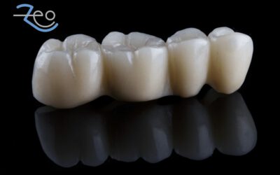 Puente dental o implante: cómo decidir cuál repone tu diente