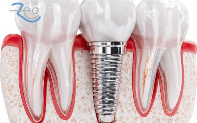 Sin hueso para implantes: qué opciones hay antes de descartarlos
