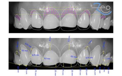 Diseño de sonrisa: qué es y cómo ver tu resultado antes de empezar