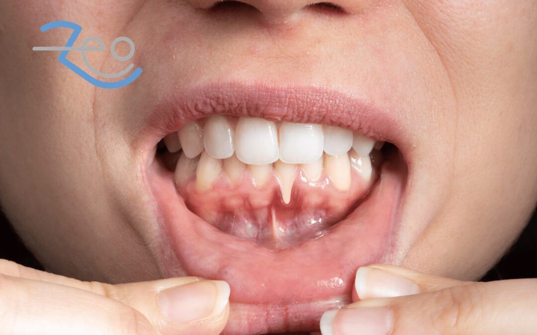 Enfermedad periodontal