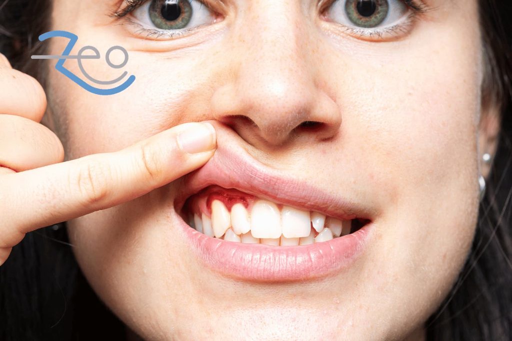 Tratamiento de la gingivitis en Las Rozas, Madrid