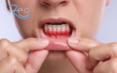 Gingivitis: por qué sangran las encías y cómo se trata